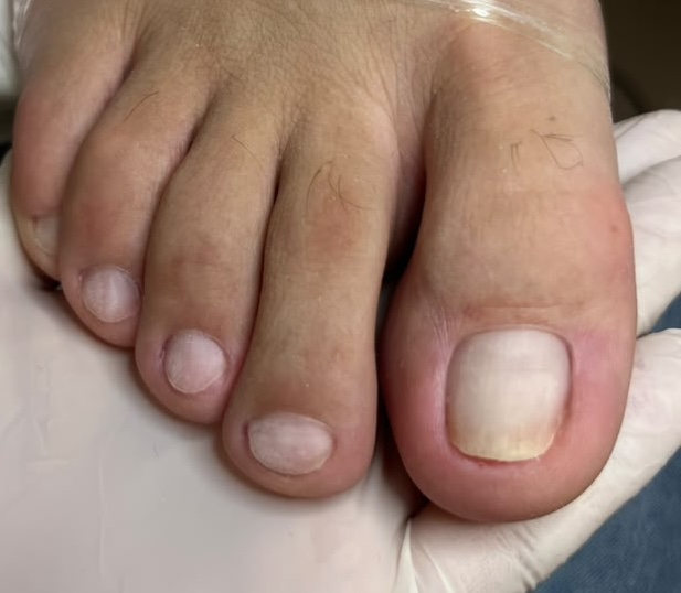 Unhas recuperadas após o protocolo de onicomicose no Centro Podal