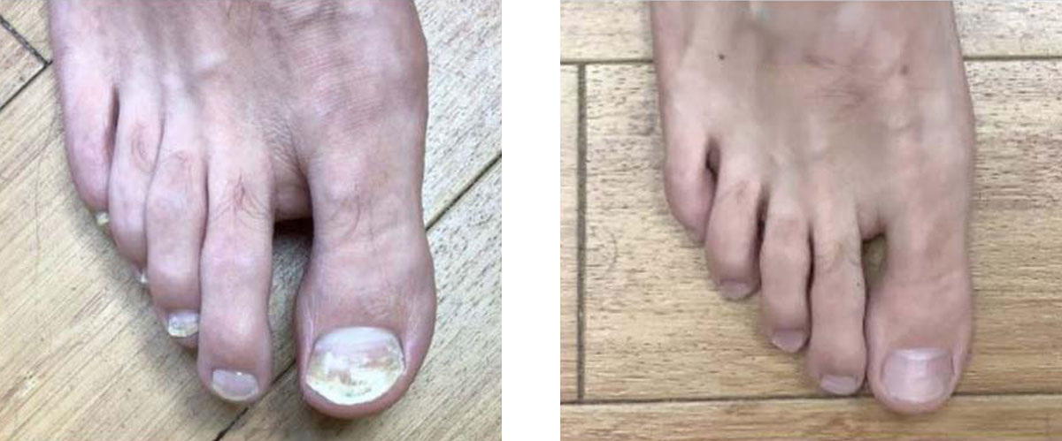 Antes e depois do tratamento de micose nas unhas no Centro Podal