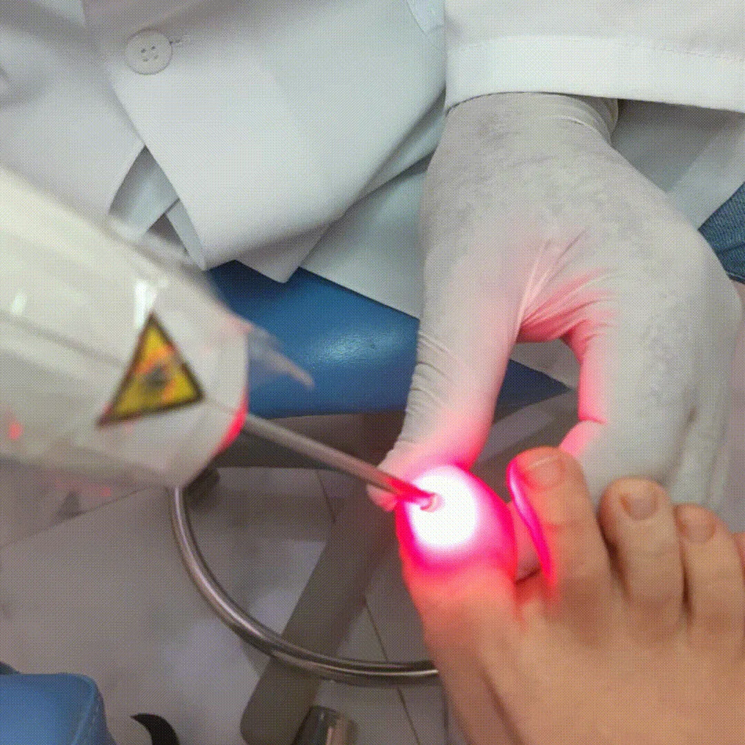 Procedimento de Laserterapia no Centro Podal