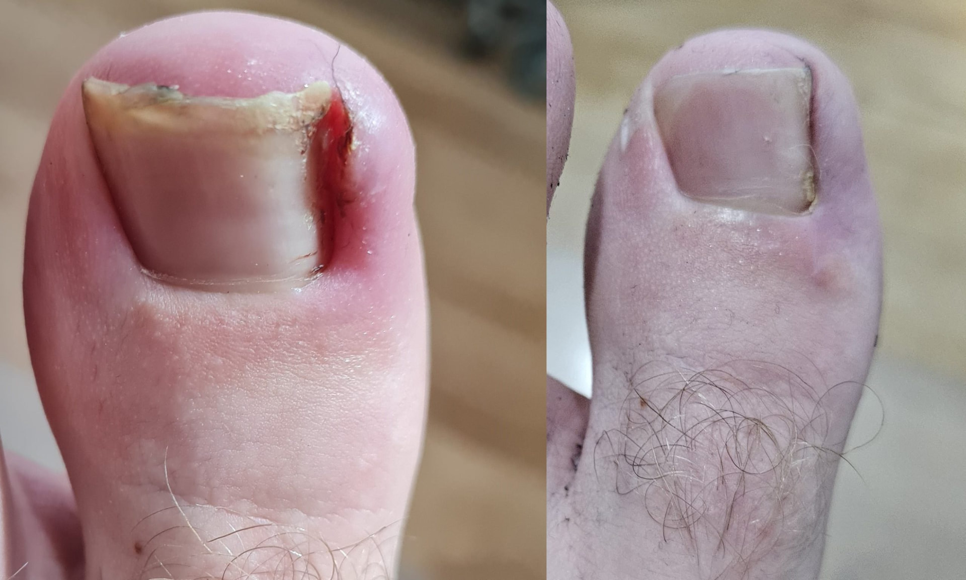 Antes e depois do tratamento de unha encravada no Centro Podal