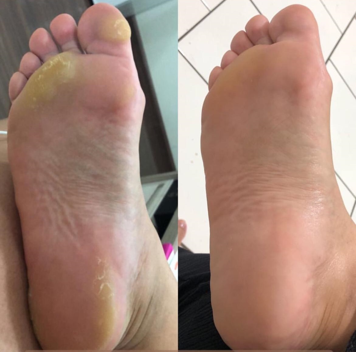 Antes e depois do tratamento de calos e calosidades no Centro Podal