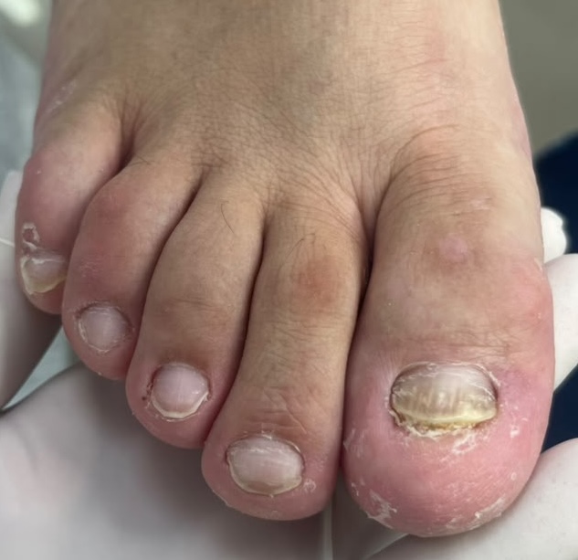 Unhas com onicomicose e descamação antes do tratamento no Centro Podal